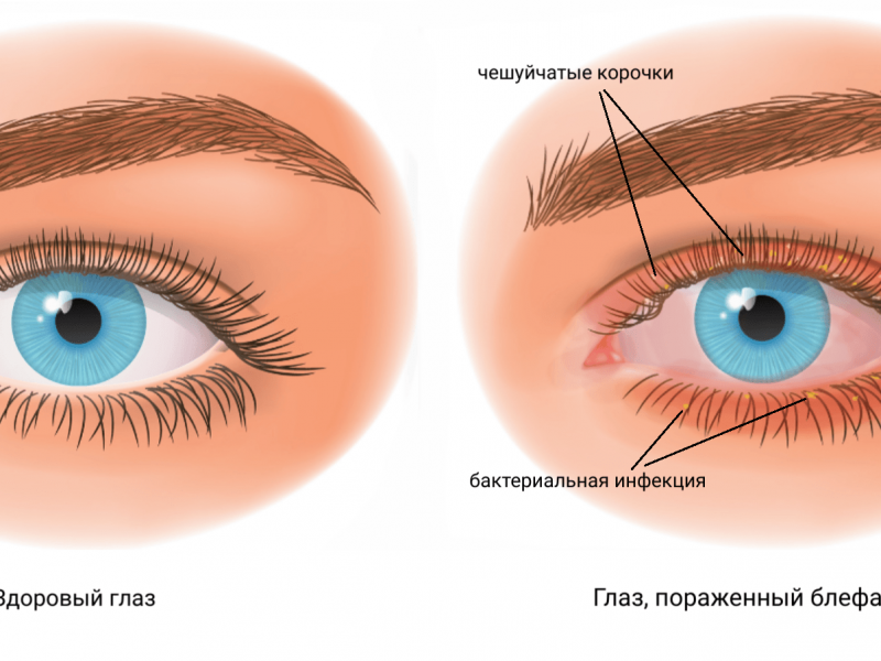 «Блефарит — основные причины, характерные симптомы и эффективные методы лечения»