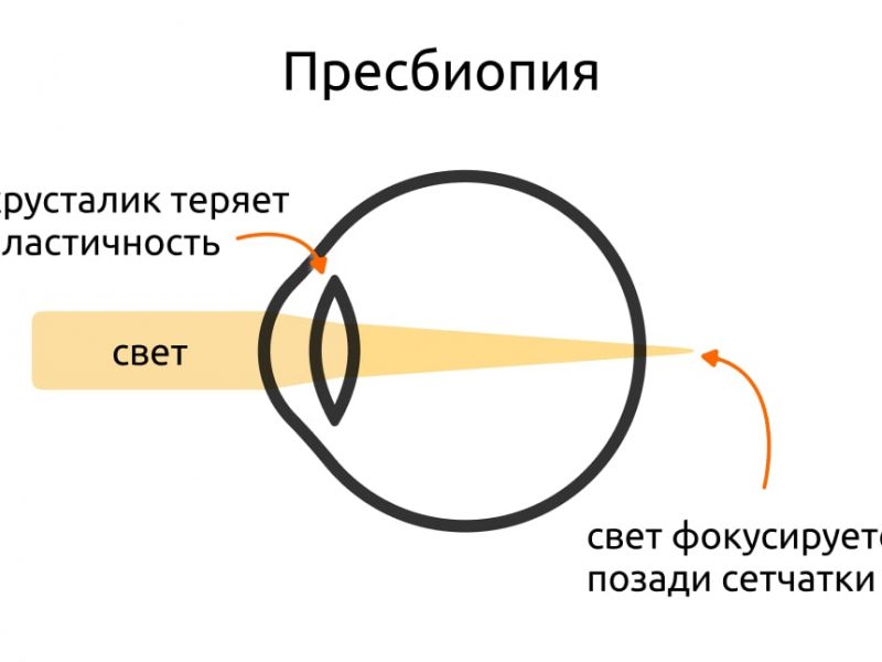 «Что такое пресбиопия, как распознать её симптомы и какие существуют методы лечения»