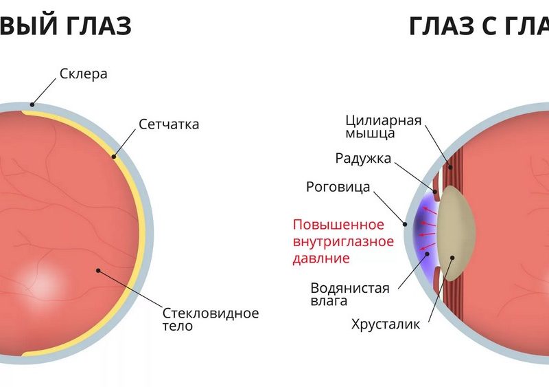 «Глаукома — признаки, факторы развития и методы терапии»