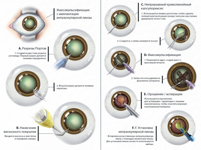 Имплантация искусственного хрусталика — что нужно знать о показаниях, возможных рисках и процессе восстановления после операции
