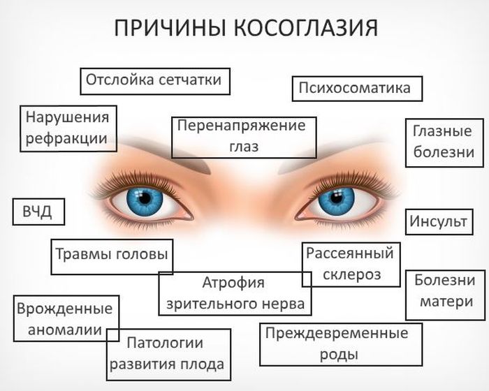 Косоглазие и его влияние на зрение причины симптомы методы лечения и профилактика этого состояния