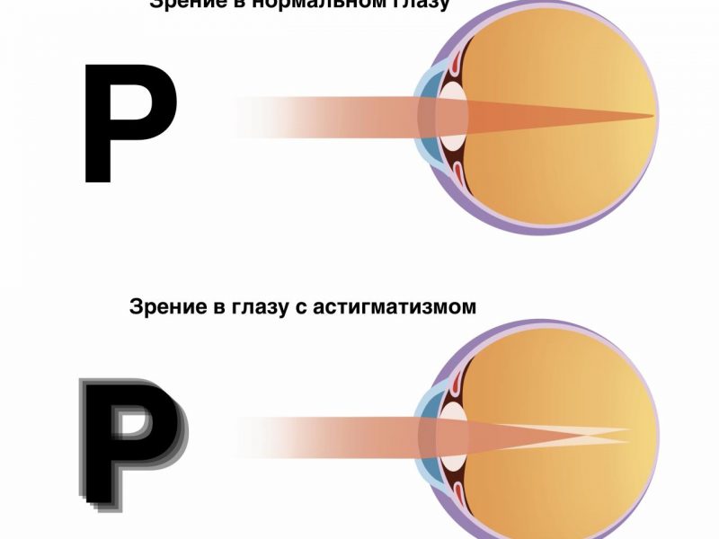 Понимание астигматизма и его влияние на зрение включая причины симптомы и методы лечения