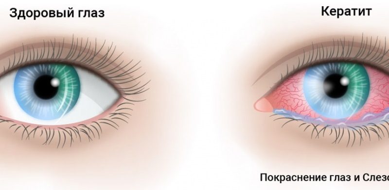 Причины, симптомы и способы лечения кератита
